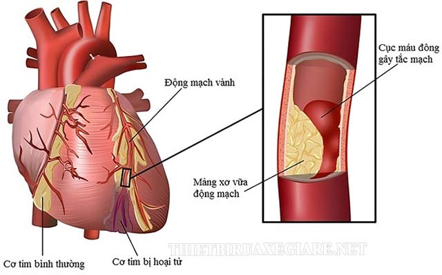 Suy mạch vành - Nguyên nhân gây suy tim thường gặp