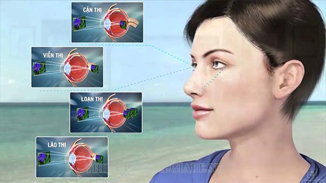 Các tật khúc xạ thường gặp ở mắt